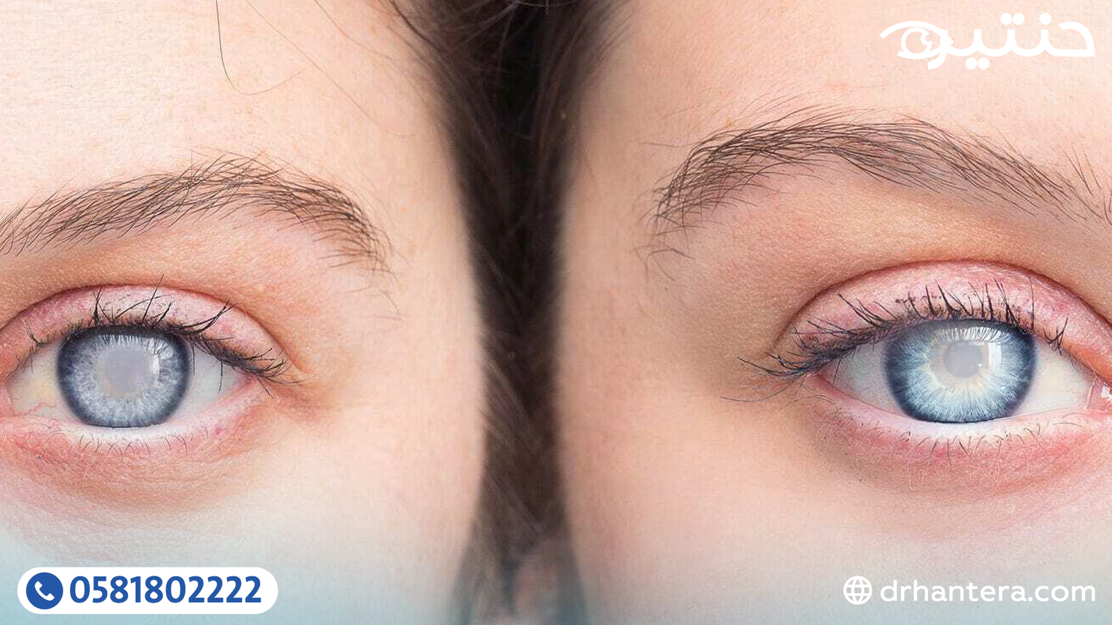 المياه البيضاء والمياه الزرقاء والمياه السوداء: إيه الفرق بينهم؟ وهل فعلًا في مياه جوه العين؟