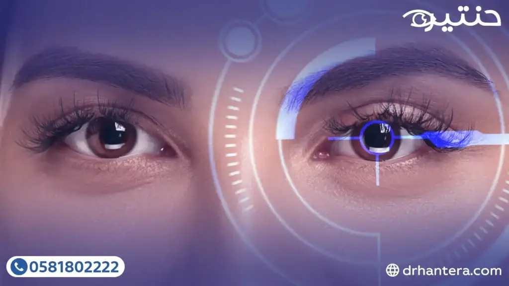 عمليات التصحيح التكميلية (LASIK Enhancement): لمسة أخيرة لرؤية مثالية في 2026