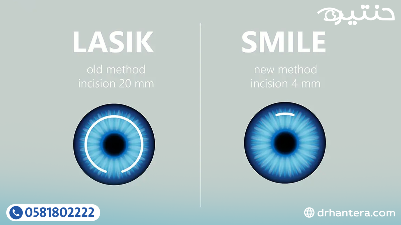 ما الفرق بين الفيمتو سمايل والليزك؟ وكيف يتم اختيار العملية المناسبة؟
