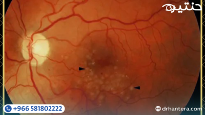 ارتشاح الشبكية بعد عملية المياه البيضاء هل الجراحة هي السبب؟