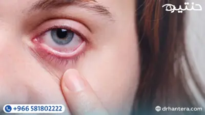 دليل جفاف العين الشامل