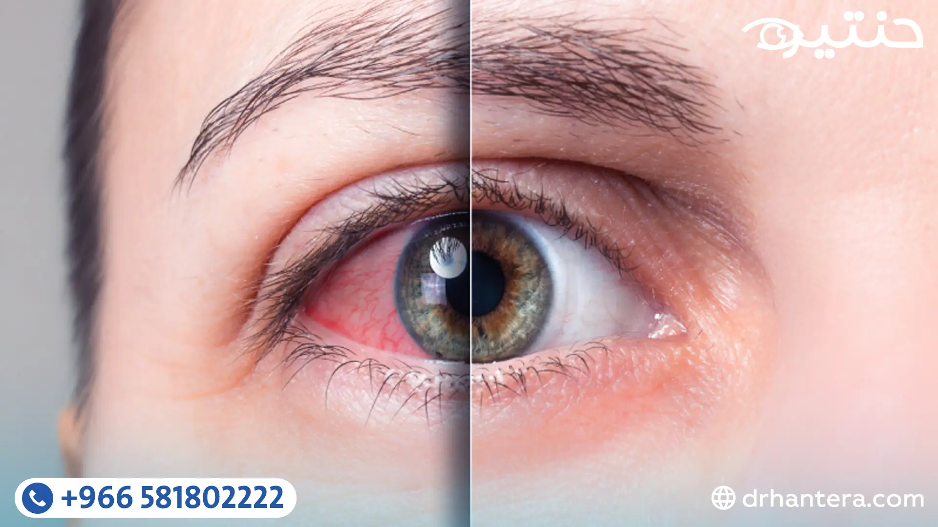 جفاف العين ليس مجرد عرض عابر