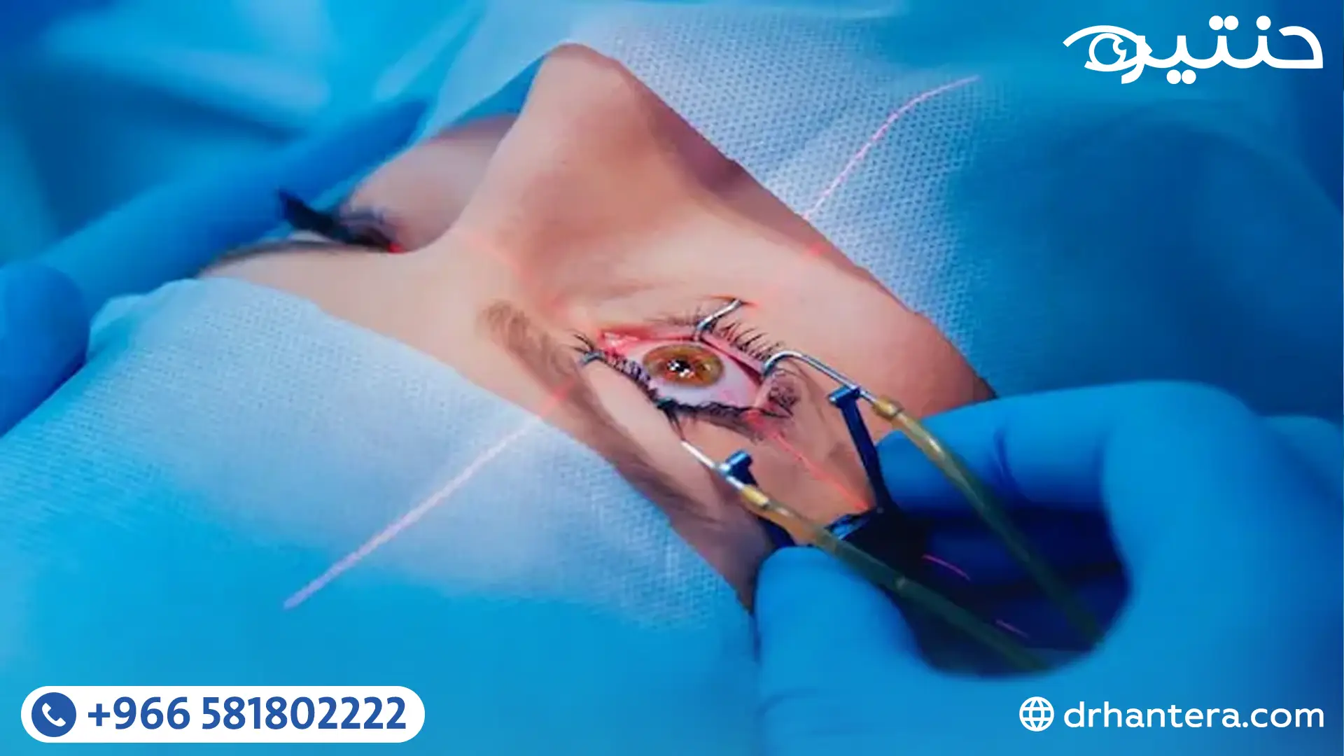 قبل عملية تصحيح الإبصار 5 نصائح ذهبية