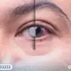 هل أُجري عملية المياه البيضاء في عين واحدة فقط؟