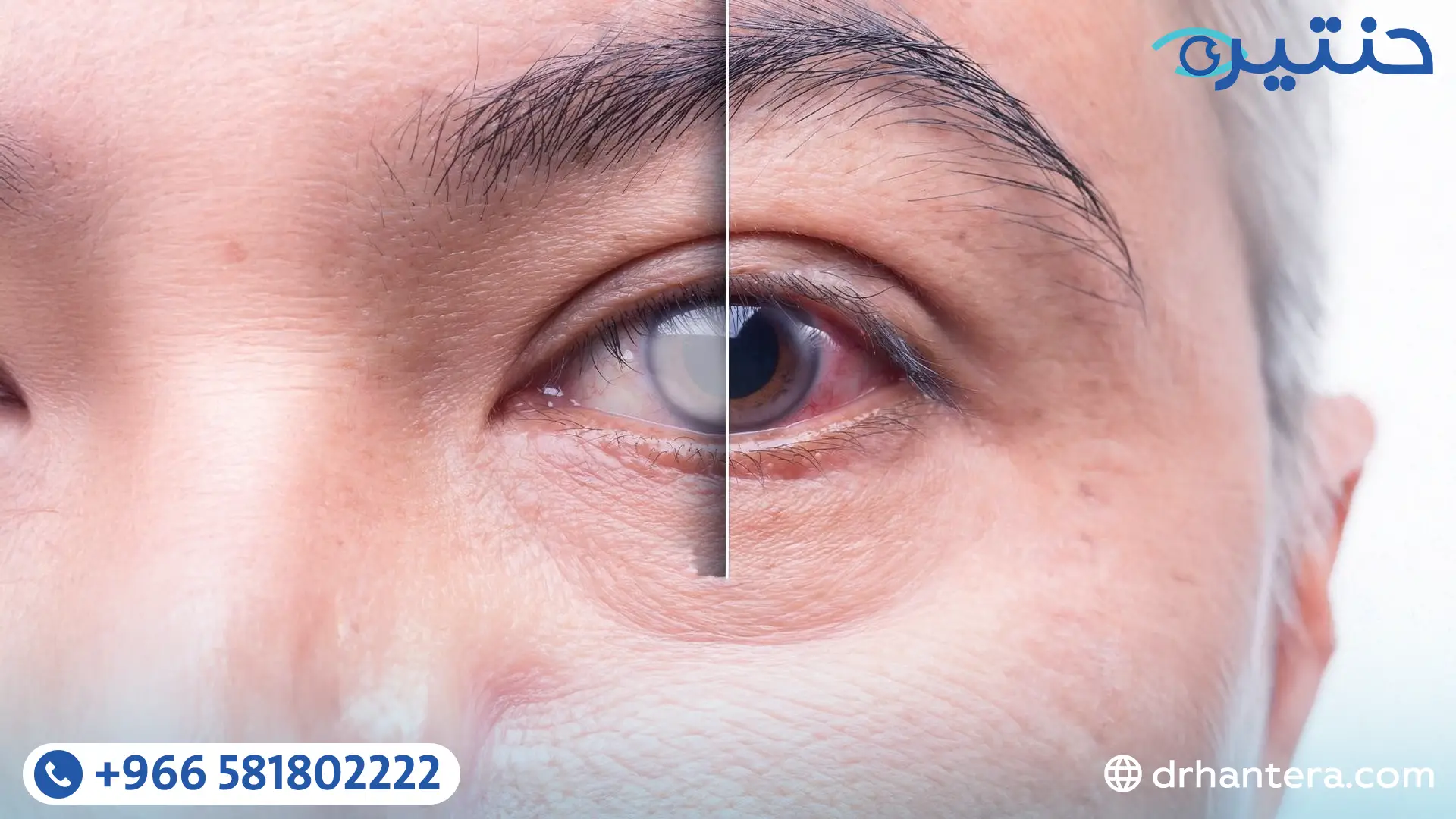 هل أُجري عملية المياه البيضاء في عين واحدة فقط؟