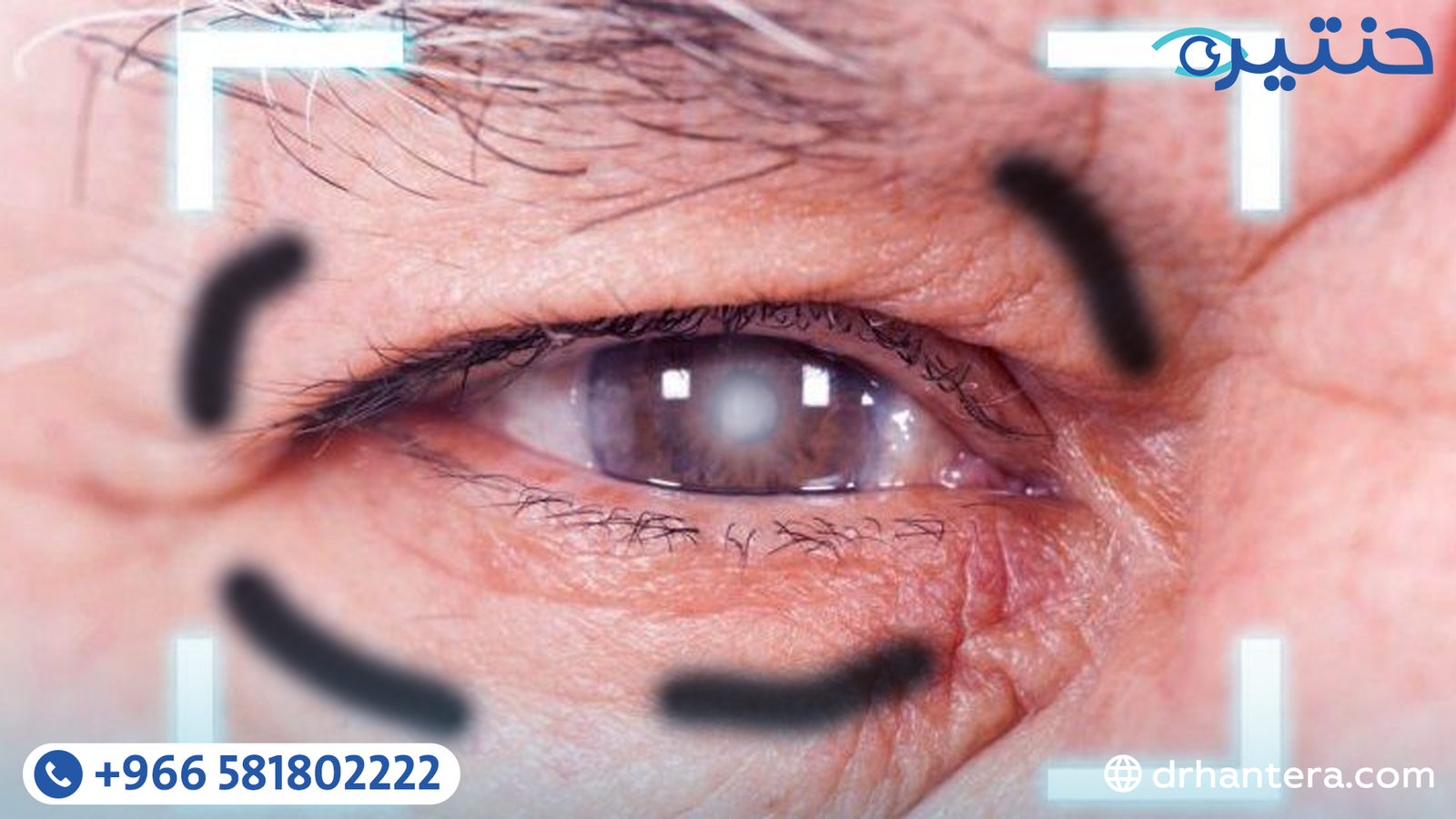 ارتشاح الشبكية بعد عملية المياه البيضاء هل الجراحة هي السبب؟