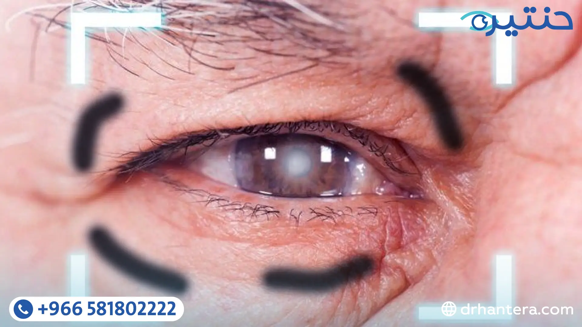 ارتشاح الشبكية بعد عملية المياه البيضاء هل الجراحة هي السبب؟