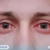 دليل جفاف العين الشامل