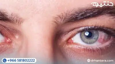 جفاف العين ليس مجرد عرض عابر