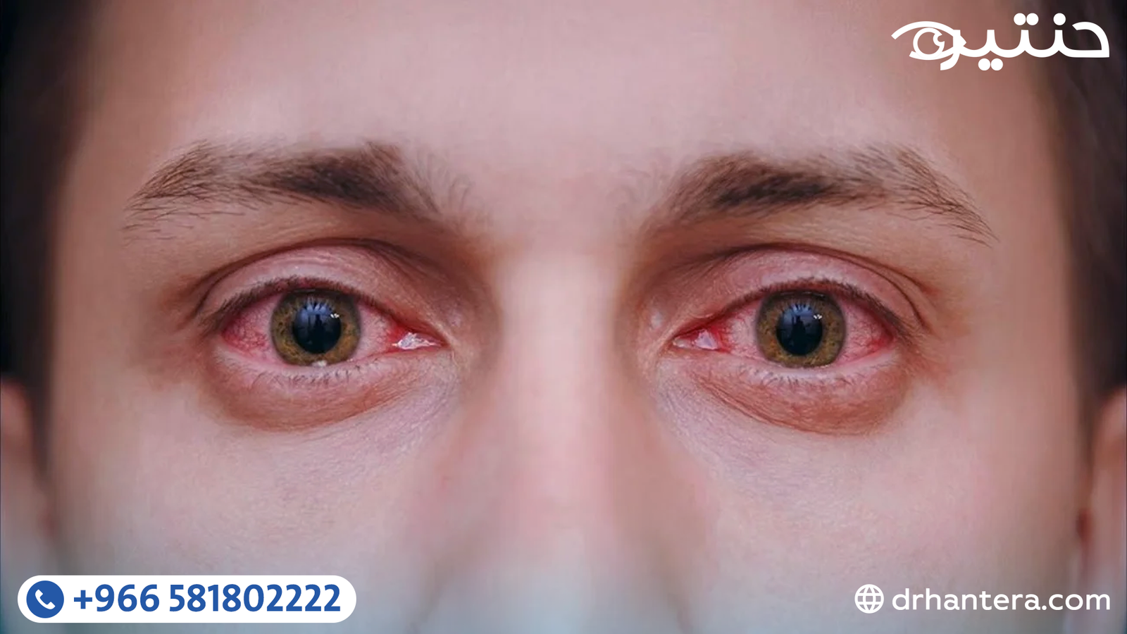 دليل جفاف العين الشامل