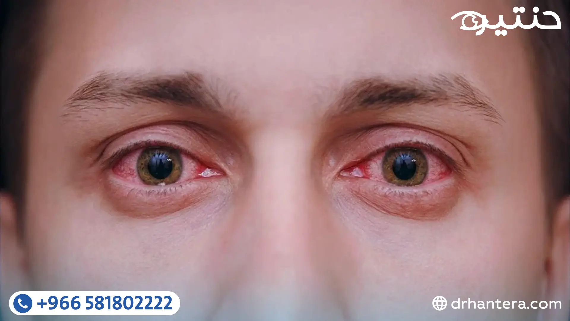 دليل جفاف العين الشامل