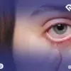10 حقائق طبية لعلاج جفاف العين في جدة مع الدكتور حنتيرة