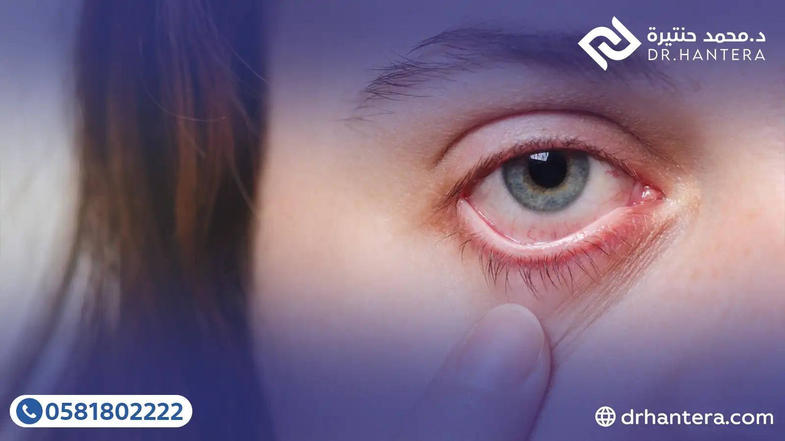 10 حقائق طبية لعلاج جفاف العين في جدة مع الدكتور حنتيرة