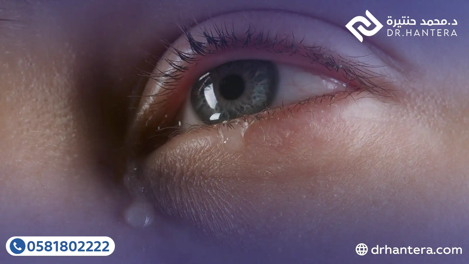 3 أسباب وراء ألم وتدمع العين المفاجئ عند الاستيقاظ مع الدكتور حنتيرة