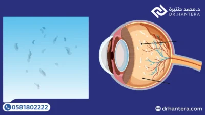 3 علامات خطر مع الذبابة الطائرة تستوجب زيارة طبيب العيون فوراً بجدة