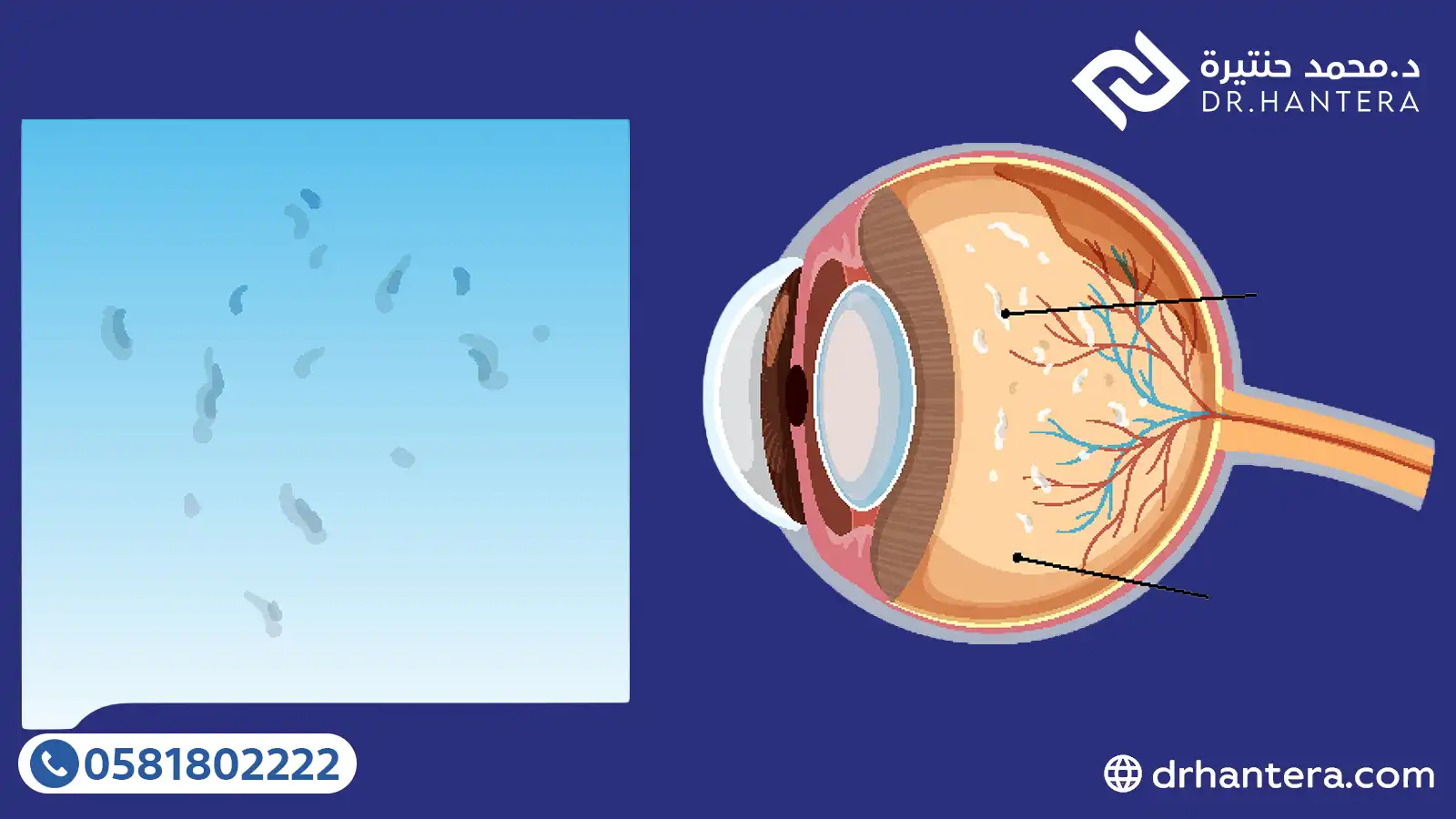 3 علامات خطر مع الذبابة الطائرة تستوجب زيارة طبيب العيون فوراً بجدة