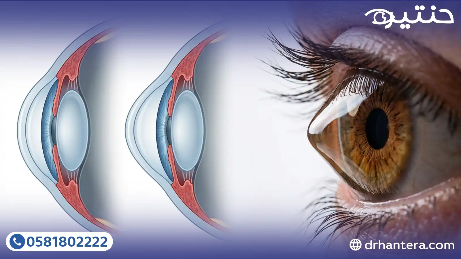 ثورة الأنسجة البشرية في علاج القرنية المخروطية لعام2026