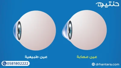 3 علامات تكشف تحول القرنية من قبةإلى مخروط
