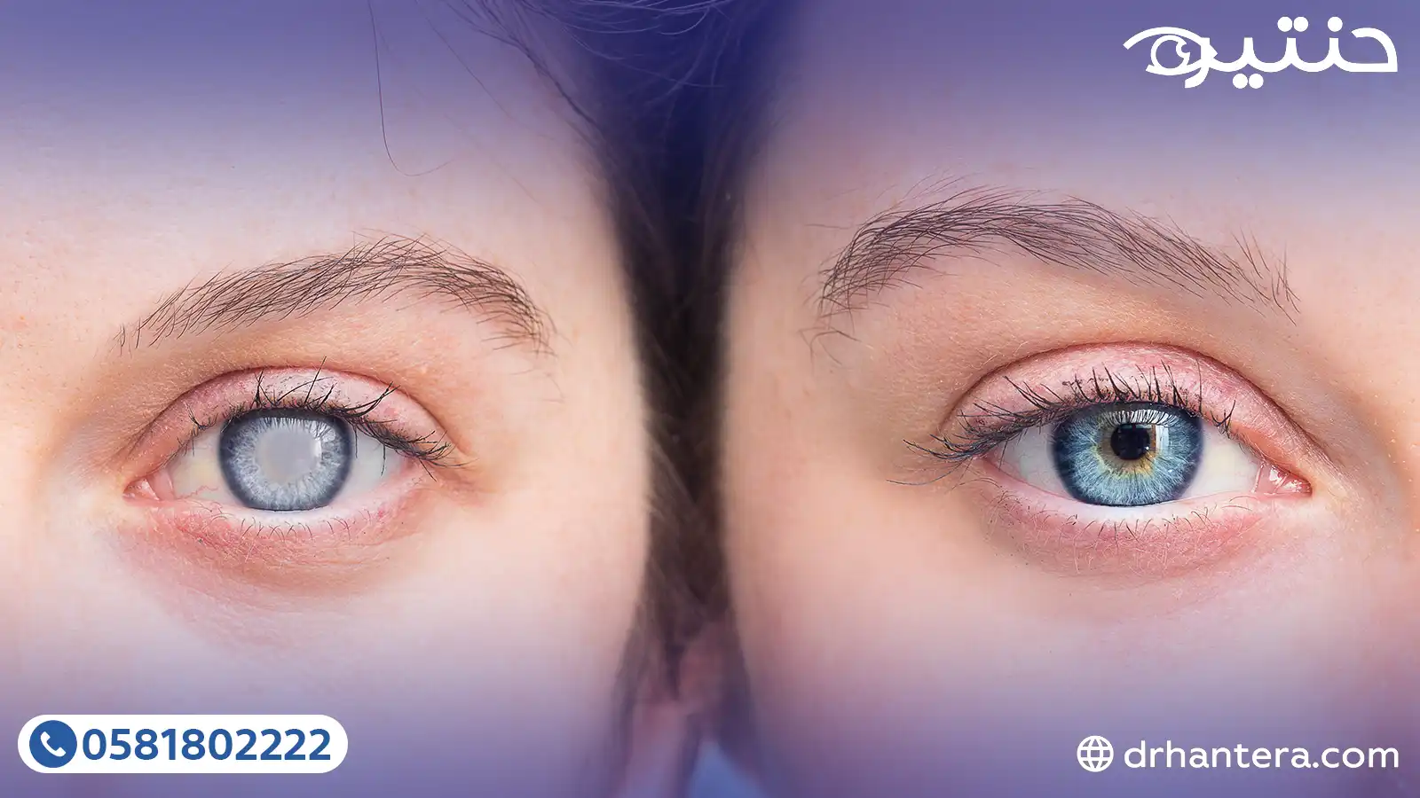 3 حقائق عن المياة البيضاء