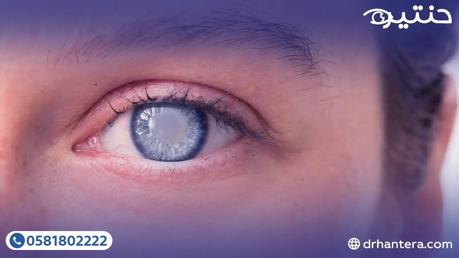 المياه البيضاء تحت سن الـ 45