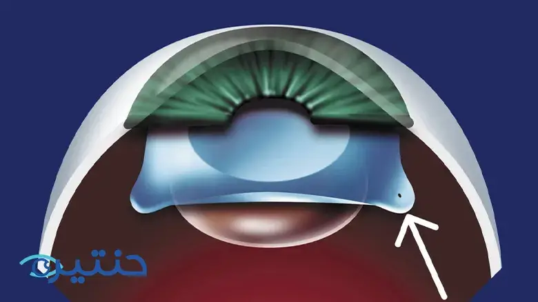 زراعة عدسات ICL
