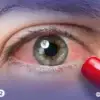 لماذا تعاني من احمرار العين الدائم