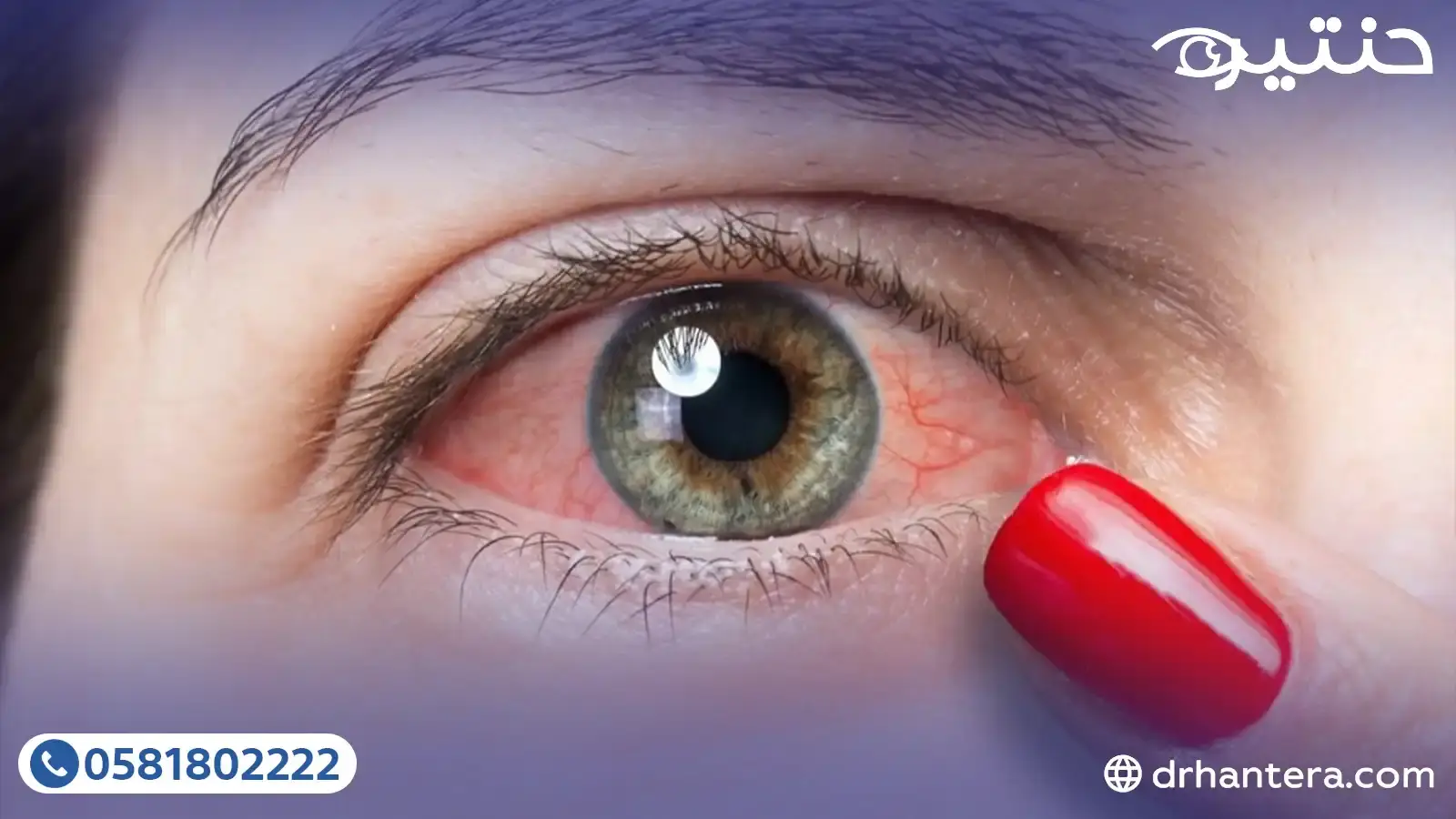 لماذا تعاني من احمرار العين الدائم