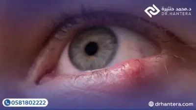 الرئيسية 9 3 نصائح ذهبية لعلاج الأكياس الدهنية المتكررة في الجفن مع الدكتور حنتيرة